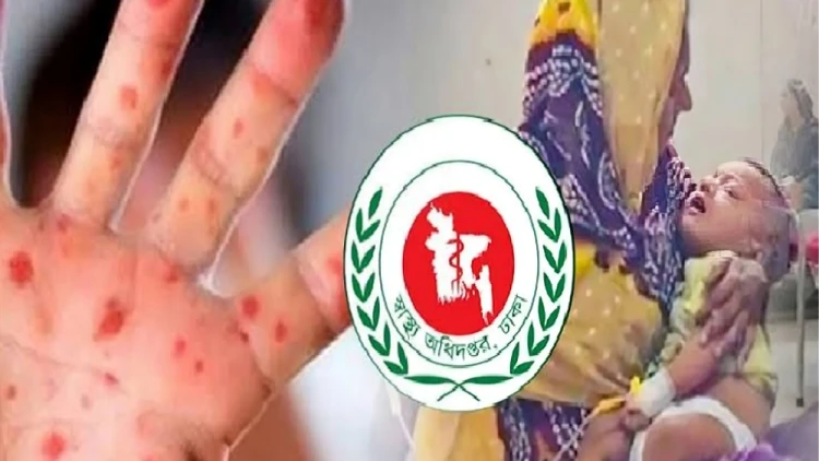 হাম ও হামের উপসর্গে আরও ৬ শিশুর মৃত্যু, আক্রান্ত ৮১৮ জন