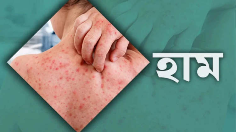 দেশে ২৪ ঘণ্টায় হামে ১১ জনের মৃত্যু