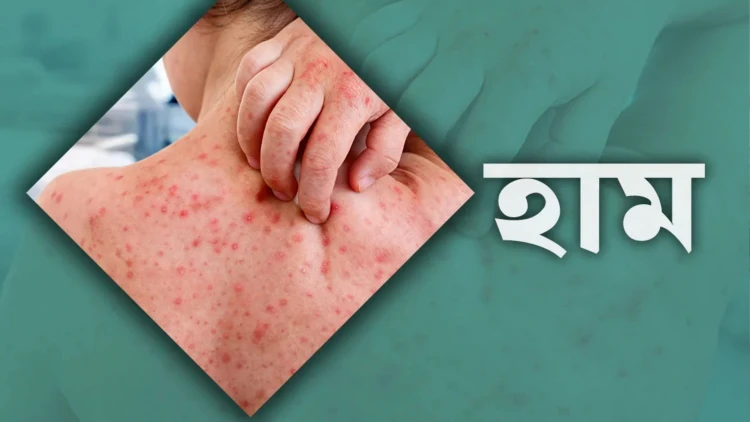 হামের উপসর্গে আরও ৮ জনের মৃত্যু, মোট প্রাণহানি ১,১২২