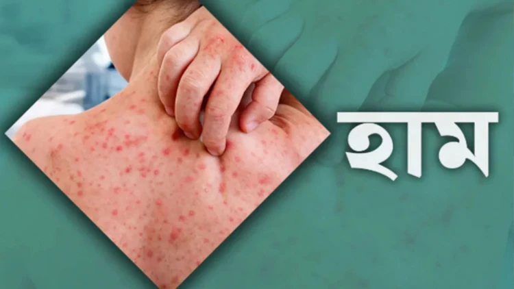 হামে  ২৪ ঘণ্টায় ৭ জনের মৃত্যু, নতুন আক্রান্ত ১৩১৯ জন